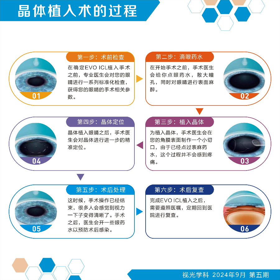 晶体植入术的过程.jpg